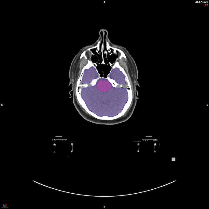 CT__BRAIN_47