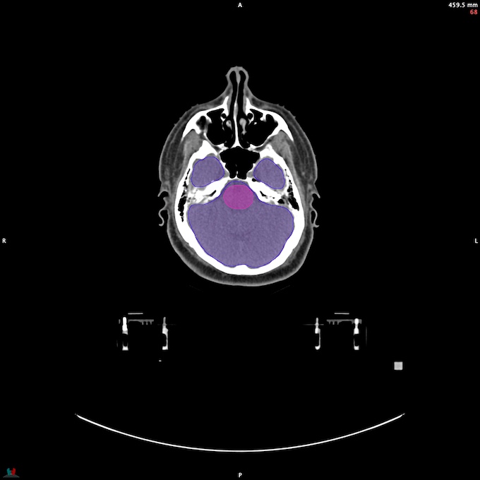 CT__BRAIN_48