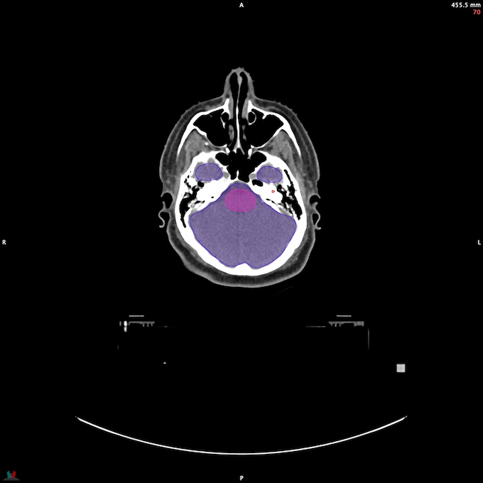 CT__BRAIN_50