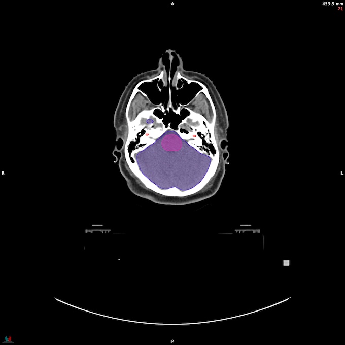 CT__BRAIN_51