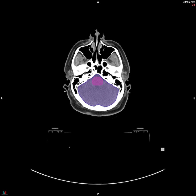 CT__BRAIN_53