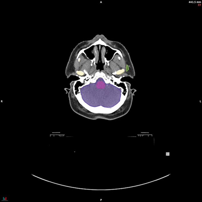 CT__BRAIN_57