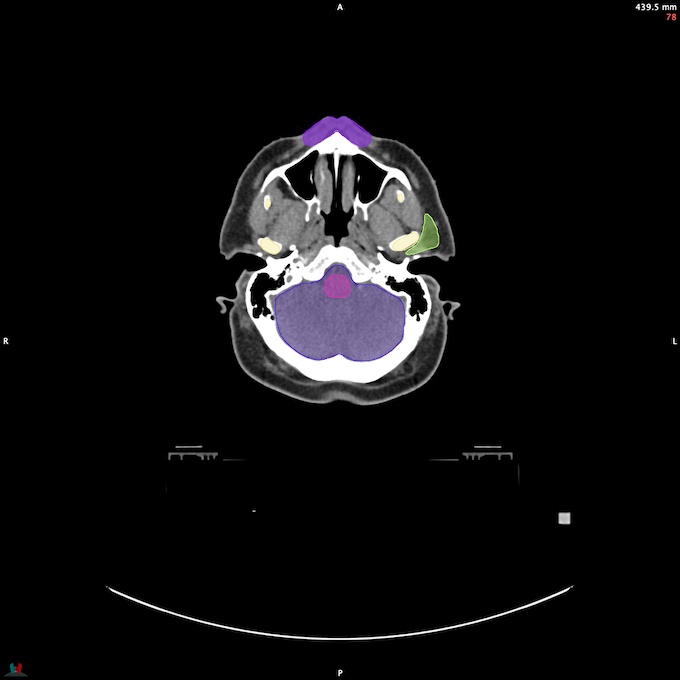 CT__BRAIN_58