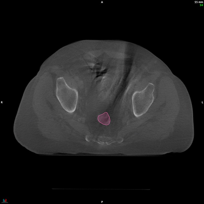 CT__RECTUM_CBCT_0