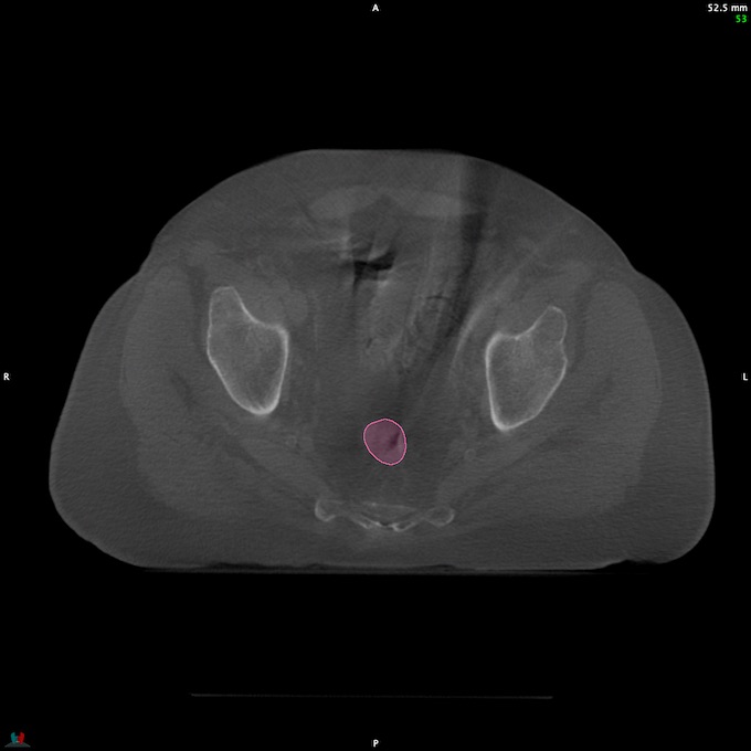 CT__RECTUM_CBCT_1