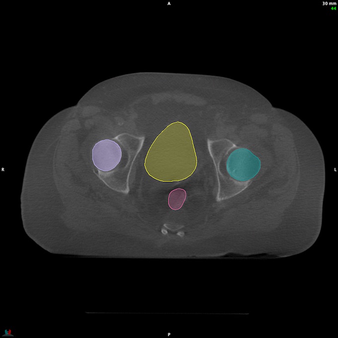 CT__RECTUM_CBCT_10