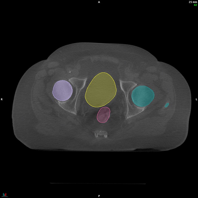 CT__RECTUM_CBCT_12