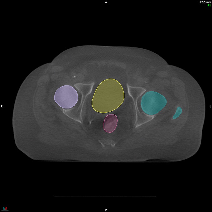 CT__RECTUM_CBCT_13