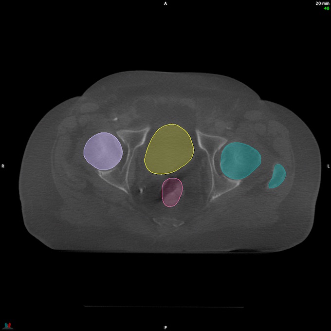 CT__RECTUM_CBCT_14