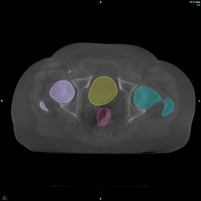 CT__RECTUM_CBCT_15