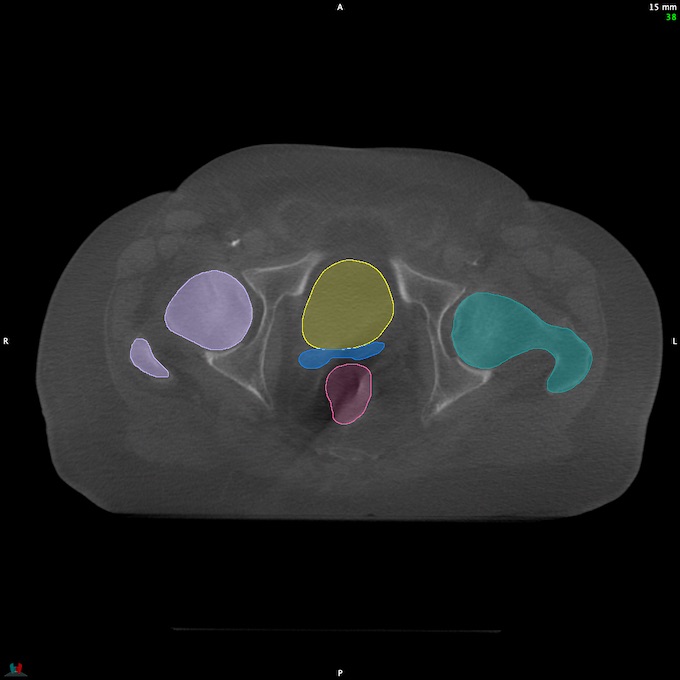 CT__RECTUM_CBCT_16