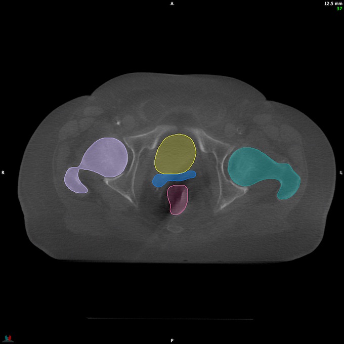 CT__RECTUM_CBCT_17