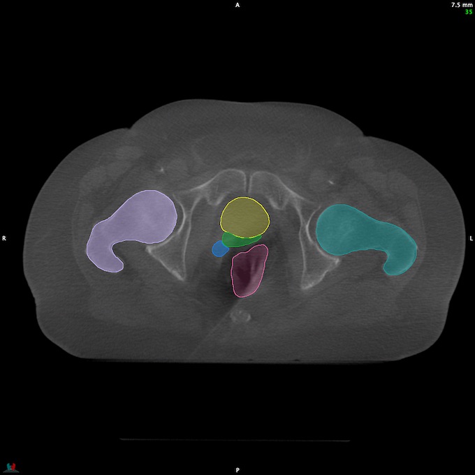 CT__RECTUM_CBCT_19