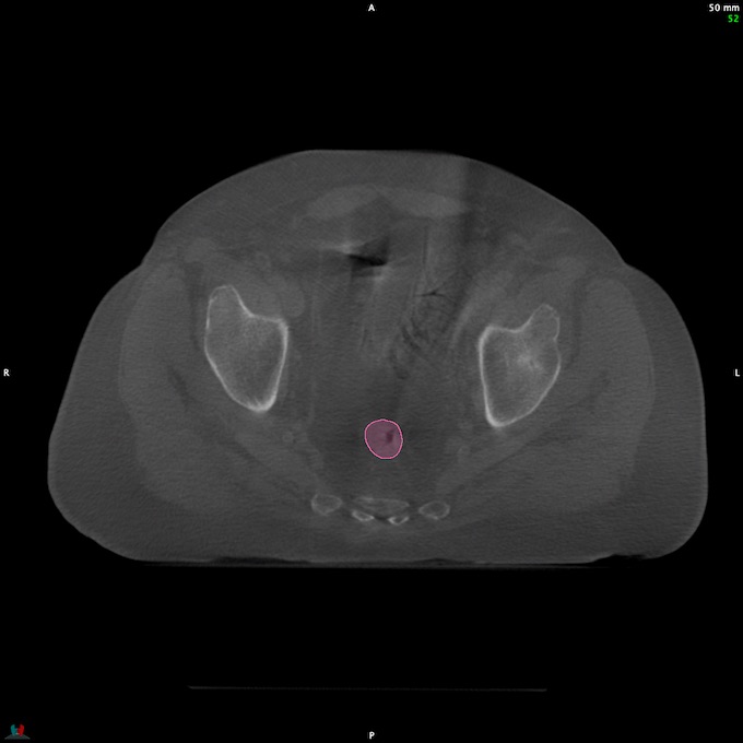 CT__RECTUM_CBCT_2