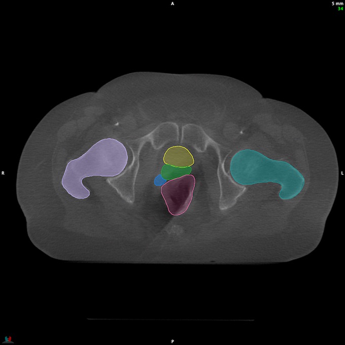 CT__RECTUM_CBCT_20