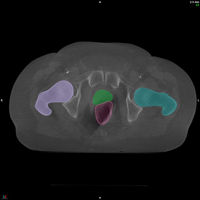 CT__RECTUM_CBCT_21