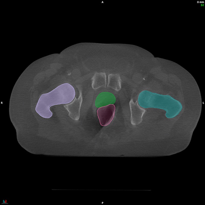 CT__RECTUM_CBCT_22