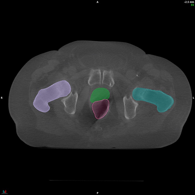 CT__RECTUM_CBCT_23