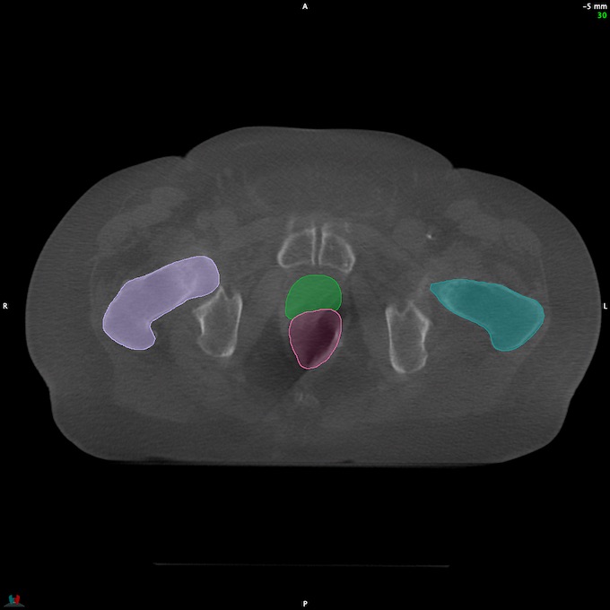 CT__RECTUM_CBCT_24