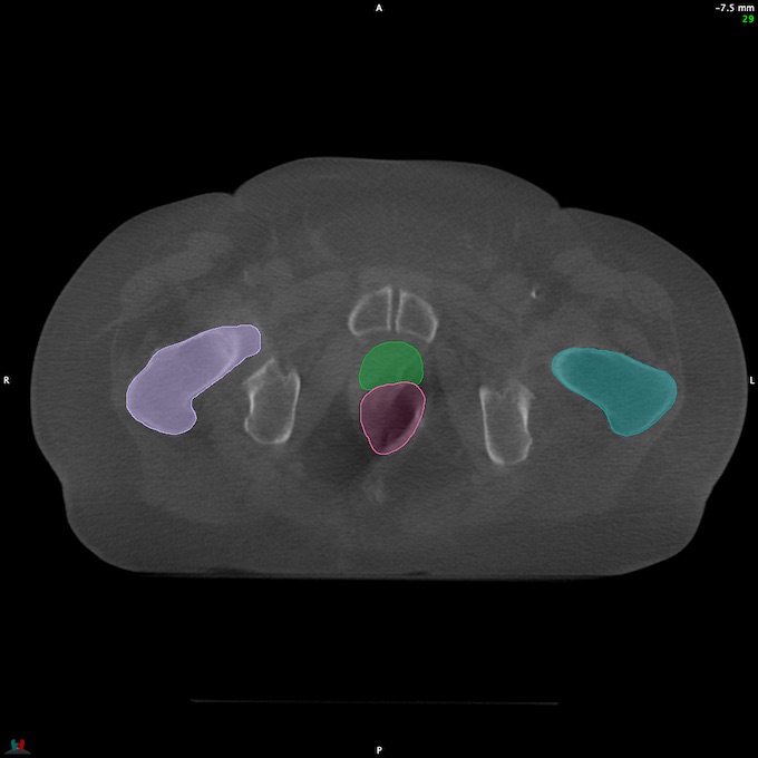 CT__RECTUM_CBCT_25