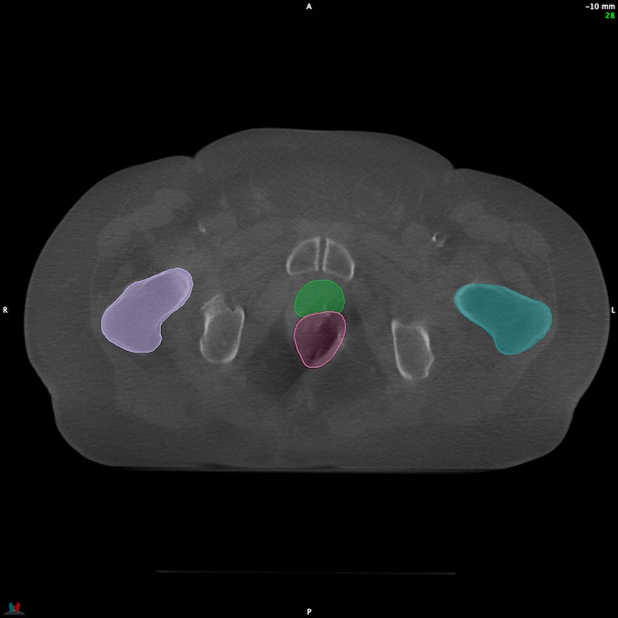 CT__RECTUM_CBCT_26