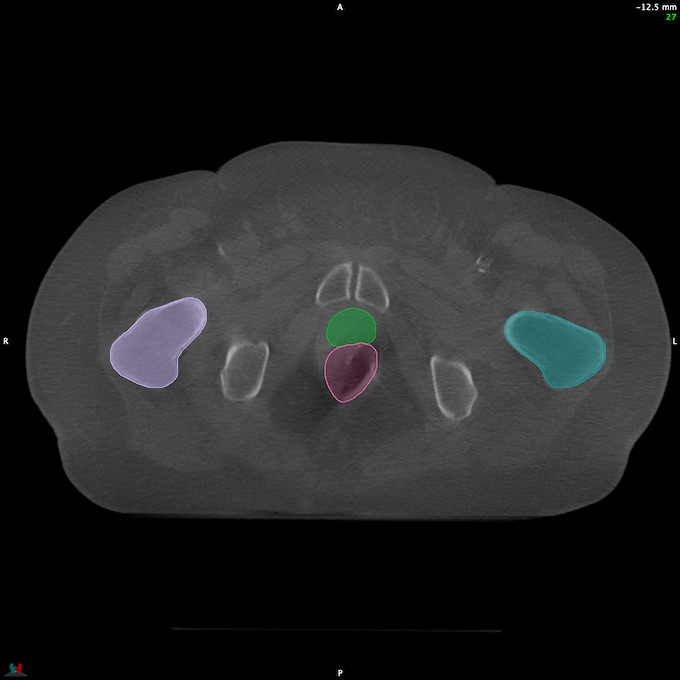 CT__RECTUM_CBCT_27