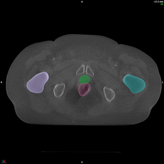 CT__RECTUM_CBCT_29