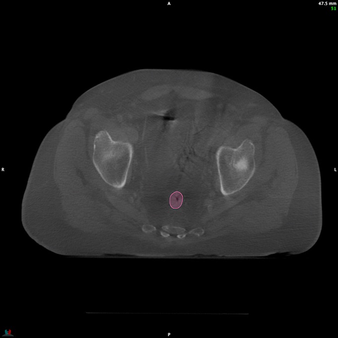 CT__RECTUM_CBCT_3