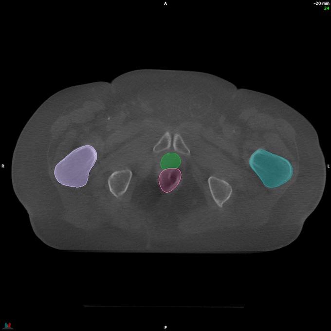 CT__RECTUM_CBCT_30