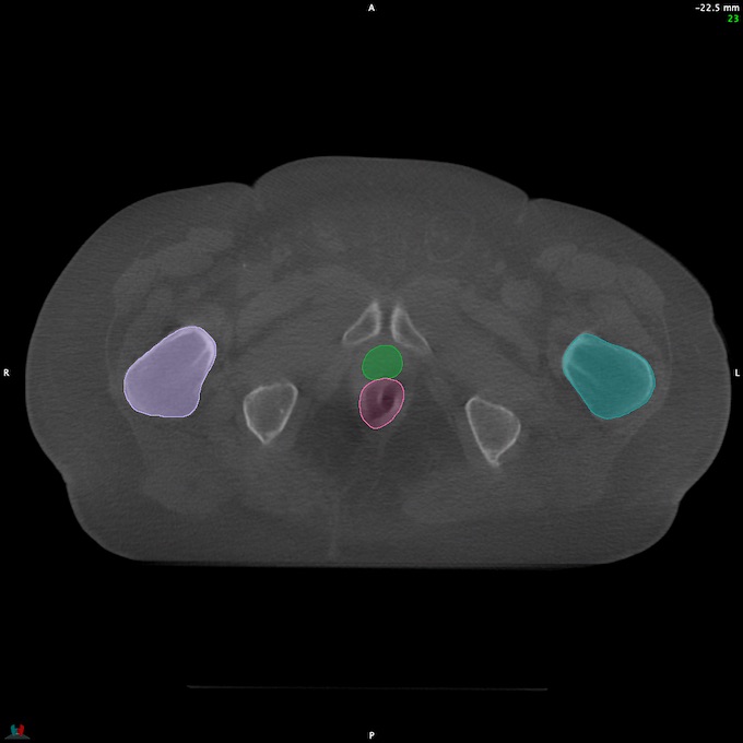 CT__RECTUM_CBCT_31