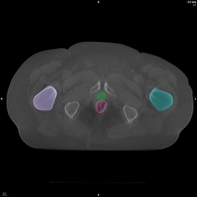 CT__RECTUM_CBCT_32