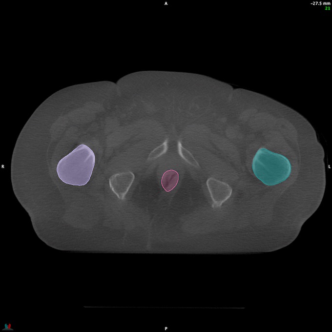 CT__RECTUM_CBCT_33