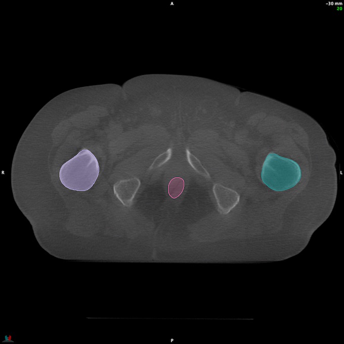 CT__RECTUM_CBCT_34