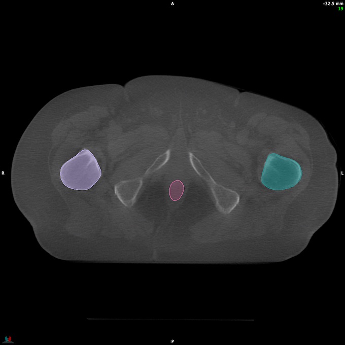 CT__RECTUM_CBCT_35