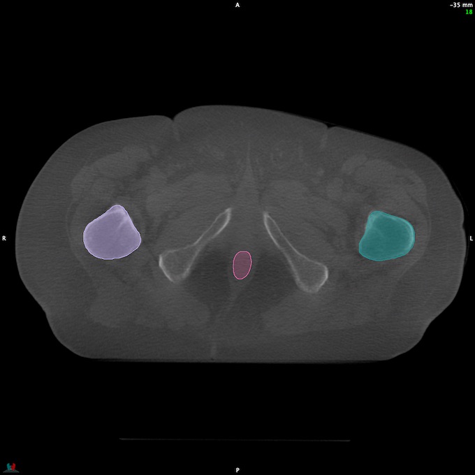 CT__RECTUM_CBCT_36