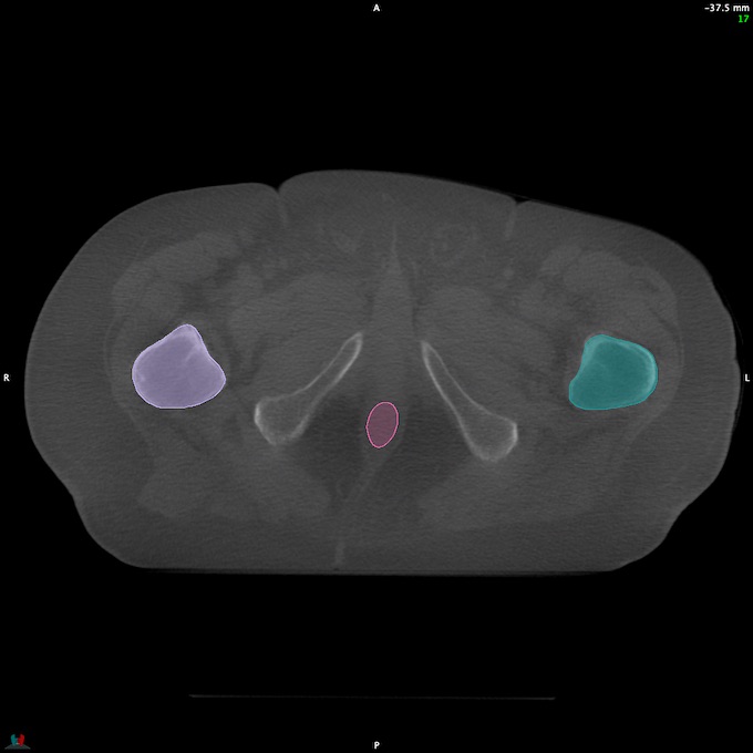 CT__RECTUM_CBCT_37