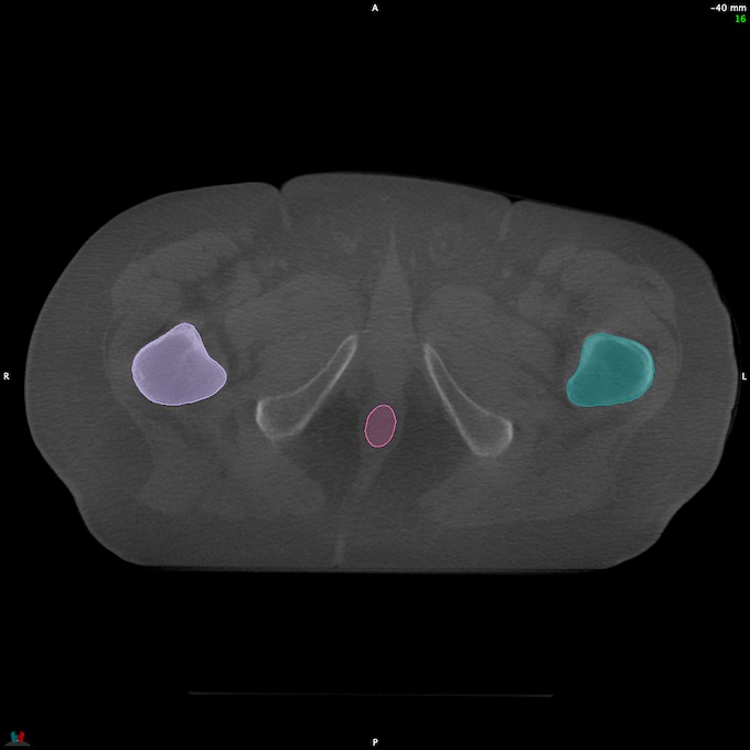 CT__RECTUM_CBCT_38