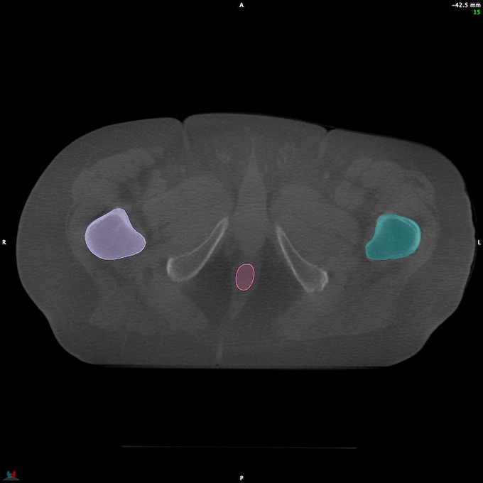 CT__RECTUM_CBCT_39