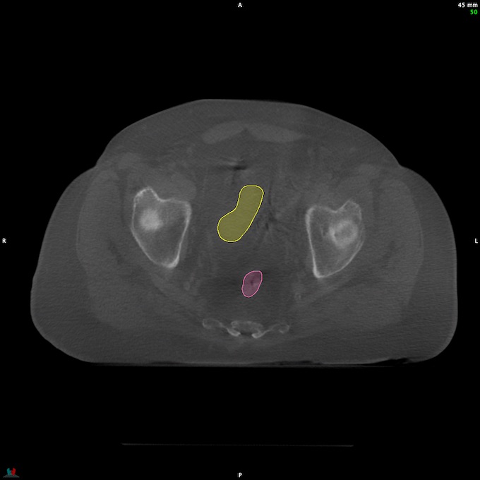 CT__RECTUM_CBCT_4