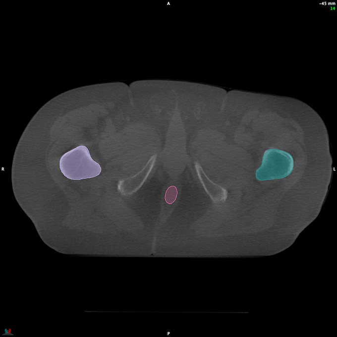 CT__RECTUM_CBCT_40