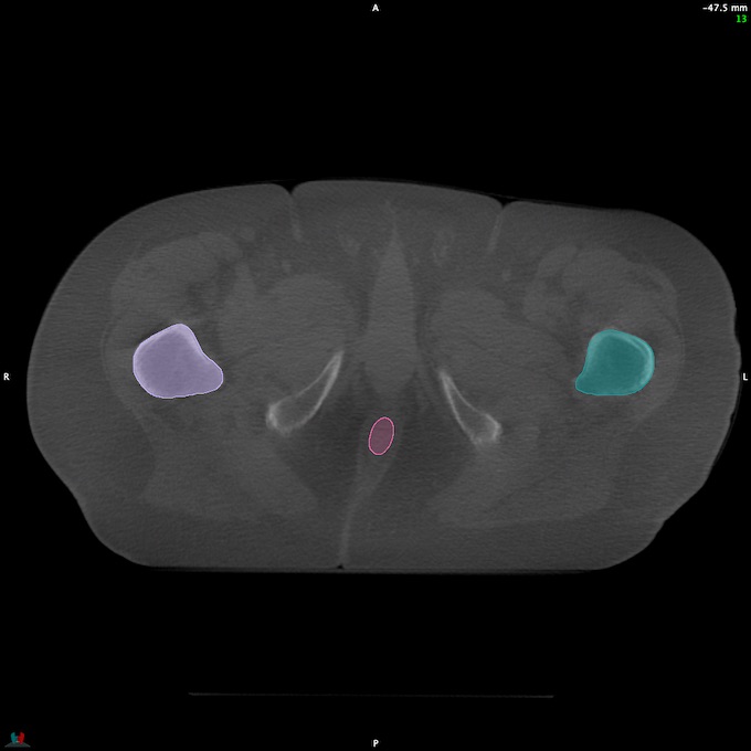 CT__RECTUM_CBCT_41