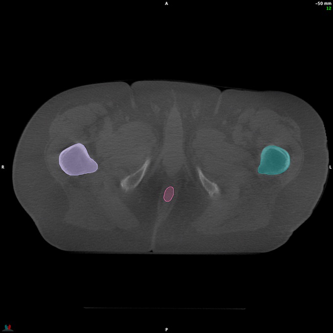 CT__RECTUM_CBCT_42