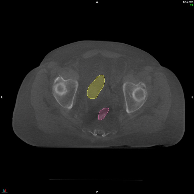 CT__RECTUM_CBCT_5