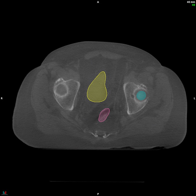 CT__RECTUM_CBCT_6