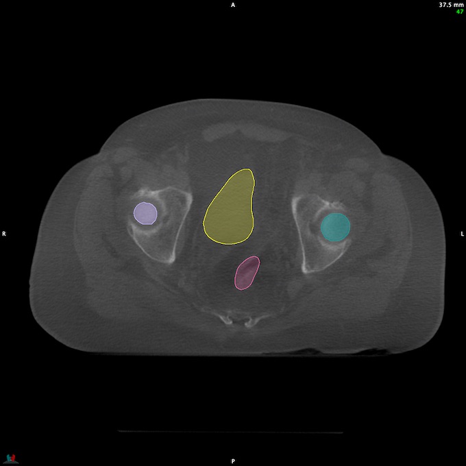 CT__RECTUM_CBCT_7