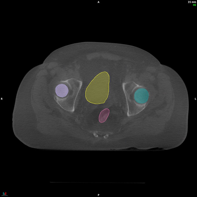 CT__RECTUM_CBCT_8