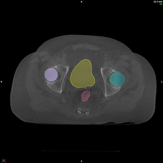 CT__RECTUM_CBCT_9