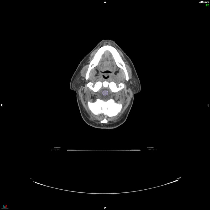 CT__SPINALCORD_1