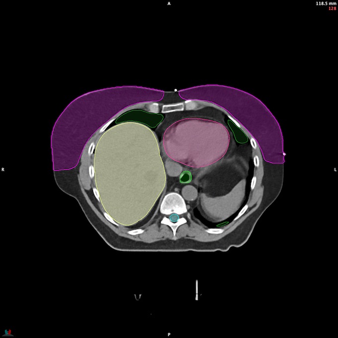 CT__SPINALCORD_101