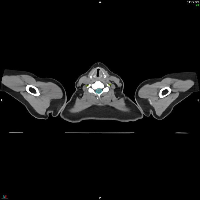 CT__SPINALCORD_15